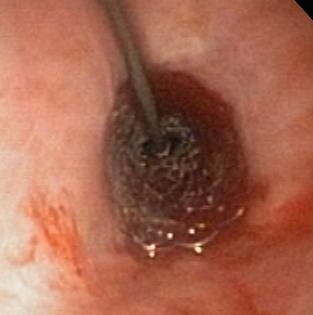 stent via scope stent via scope